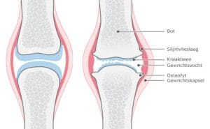 Illustratie: vergelijking tussen een gezond kniegewricht en een gewricht met artrose.