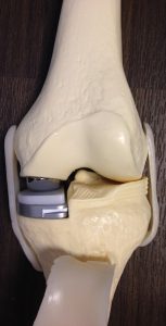 Anatomisch model van een halve knie prothese